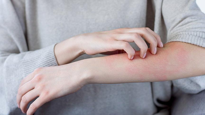 CHP'li Sertel, İzmir'de artan 'uyuz' vakalarını TBMM'ye taşıdı