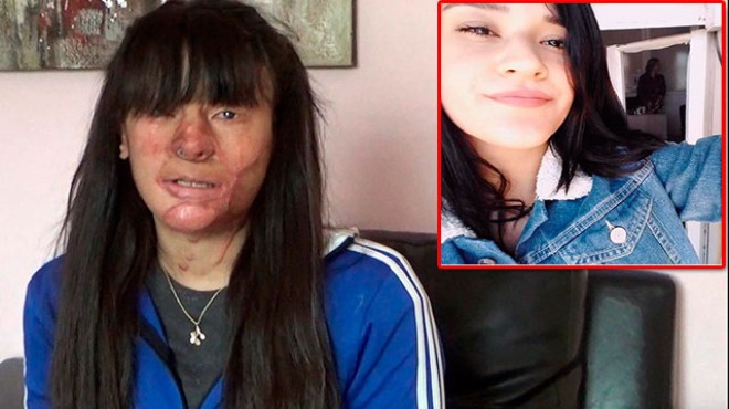 Berfin'den şok karar... Asitli saldırganı affetti! 