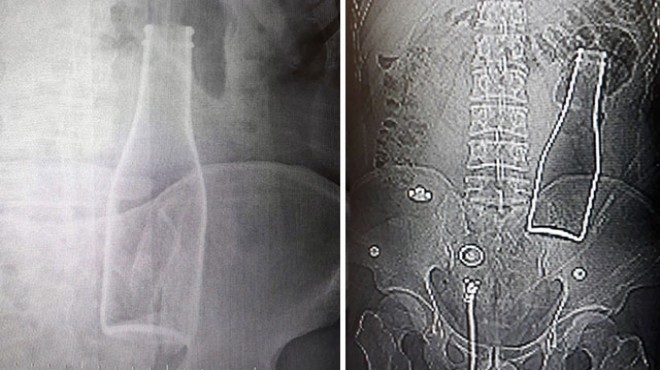 Karın ağrısı şikayetiyle gitti: Doktorlar şoke oldu!