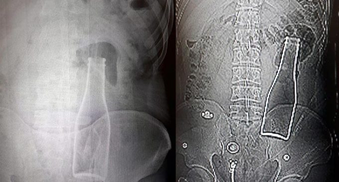 Vücudundan şişe çıkan genç konuştu: Yanlışlıkla oldu