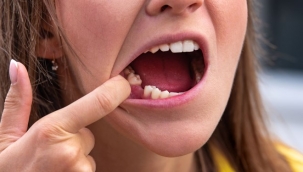 Koronavirüs ani ve acısız diş kaybına neden olabilir