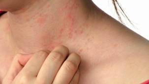 Pandemide uyuz vakaları arttı