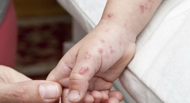 Maymun çiçeği vaka sayısı beşe yükseldi!