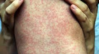 Avrupa'da kızamık ve boğmaca alarmı