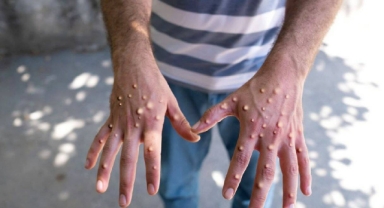 Ankara’da M Çiçeği alarmı 