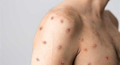 Bakan Memişoğlu'ndan maymun çiçeği açıklaması: 