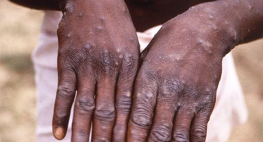 Maymun çiçeği nedir? Nasıl bulaşır?