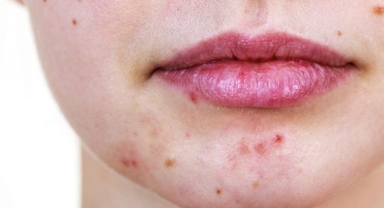 Uzmanlar seslendi: Sivilcelerinizi patlatmayın 