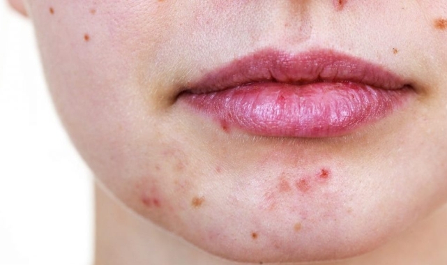 Uzmanlar seslendi: Sivilcelerinizi patlatmayın